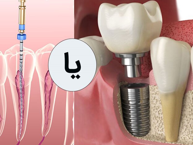 ایمپلنت دندان بهتر است یا عصب کشی دندان