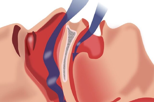 آپنه خواب خطر ابتلا به پارکینسون را افزایش میدهد اما چاره دارد آپنه خواب خطر ابتلا به پارکینسون را افزایش میدهد اما چاره دارد