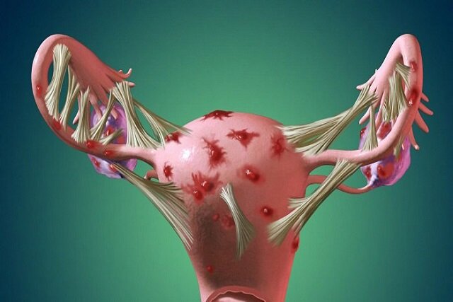 همه چیز درباره «اندومتریوز» و دردهای شدید دوران قاعدگی