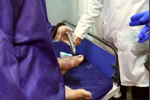 روش پلاسما، زخم دیابتی ۱۲۰ بیمار را در کرج درمان کرد روش پلاسما، زخم دیابتی ۱۲۰ بیمار را در کرج درمان کرد