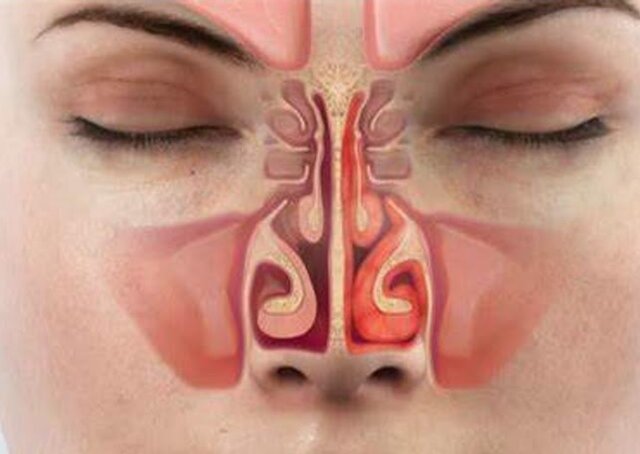 آلرژی فصلی چطور درمان میشود؟ آلرژی فصلی چطور درمان میشود؟