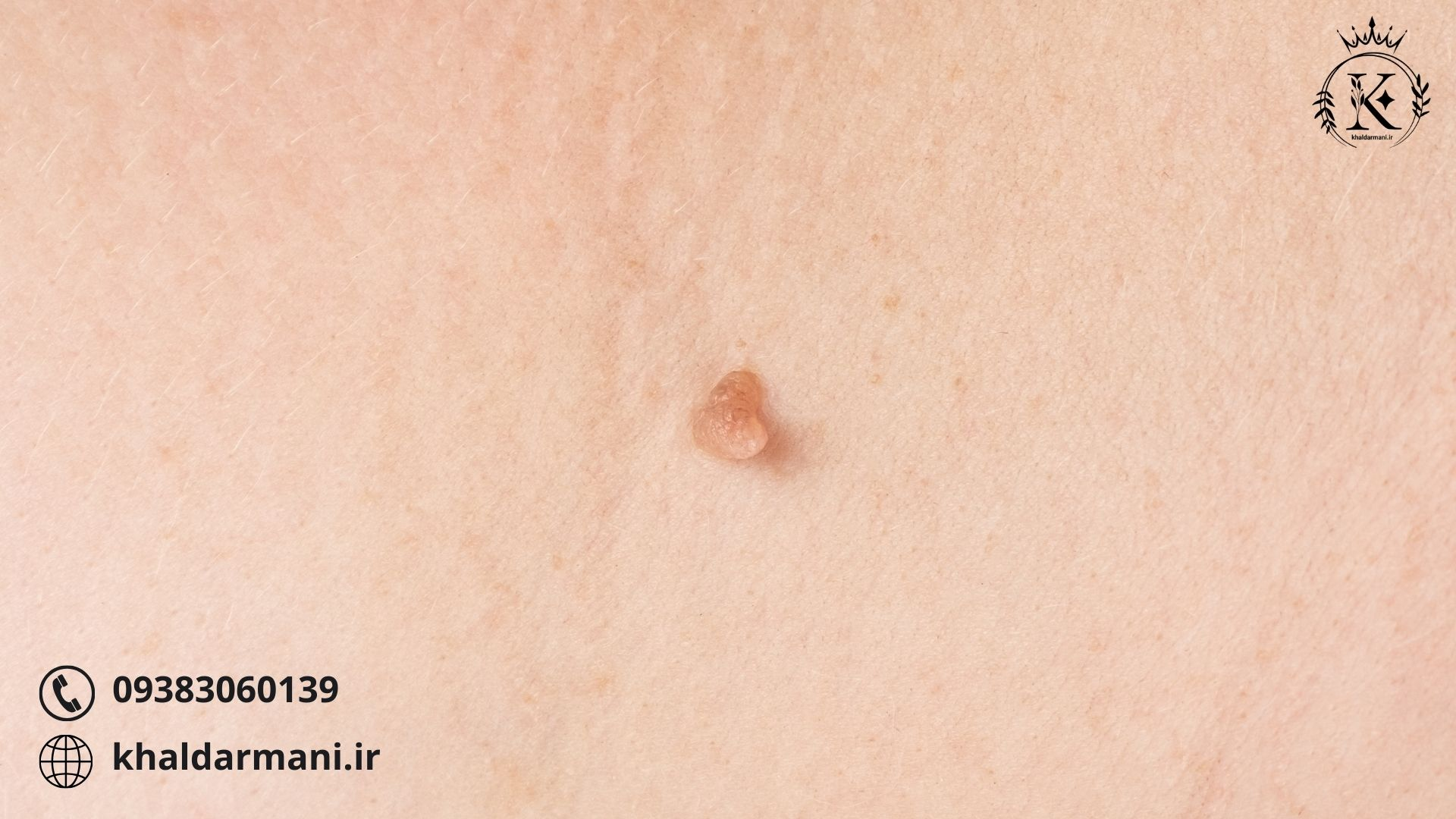 ۱۲ راهکار عملی درمان زگیل با گیاهان دارویی در خانه