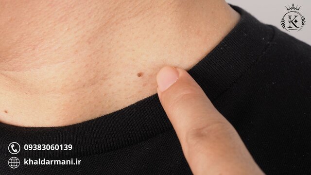 ۱۲ راهکار عملی درمان زگیل با گیاهان دارویی در خانه