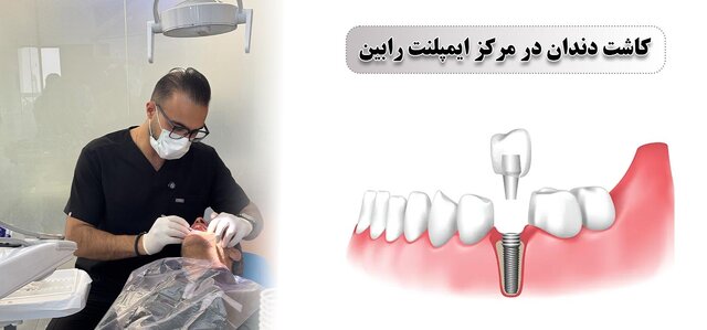 کاشت دندان در مرکز ایمپلنت رابین /مراحل کاشت دندان در مرکز ایمپلنت