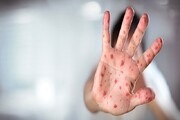 تایید رسمی حذف سرخک و سرخجه در ایران تا سال ۲۰۲۳