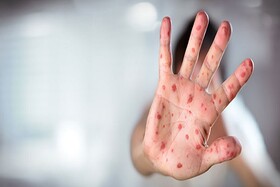 کاهش موارد سرخک در مشهد نسبت به سال گذشته