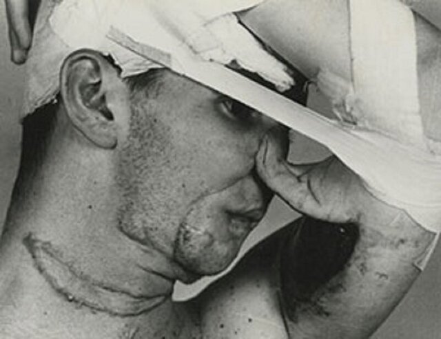 تاریخچه عملهای زیبایی/ اولین جراحی زیبایی تاریخ کِی انجام شد؟