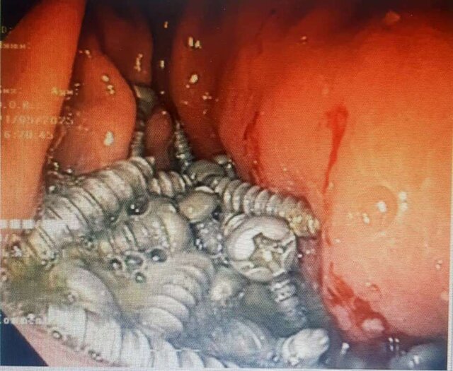 خارج کردن ۴۷ پیچ از معده یک بیمار در کرج! خارج کردن ۴۷ پیچ از معده یک بیمار در کرج!