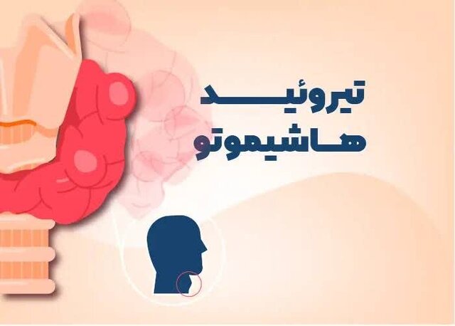 علائم بیماری هاشیموتو