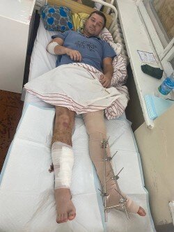 جراحت شدید چهره مطرح ورزش اوکراین در جنگ + عکس