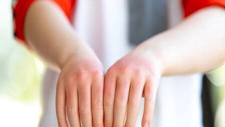 آب آوردن مفصل، نشانهای مهم از روماتیسم مفصلی در کودکان آب آوردن مفصل، نشانهای مهم از روماتیسم مفصلی در کودکان