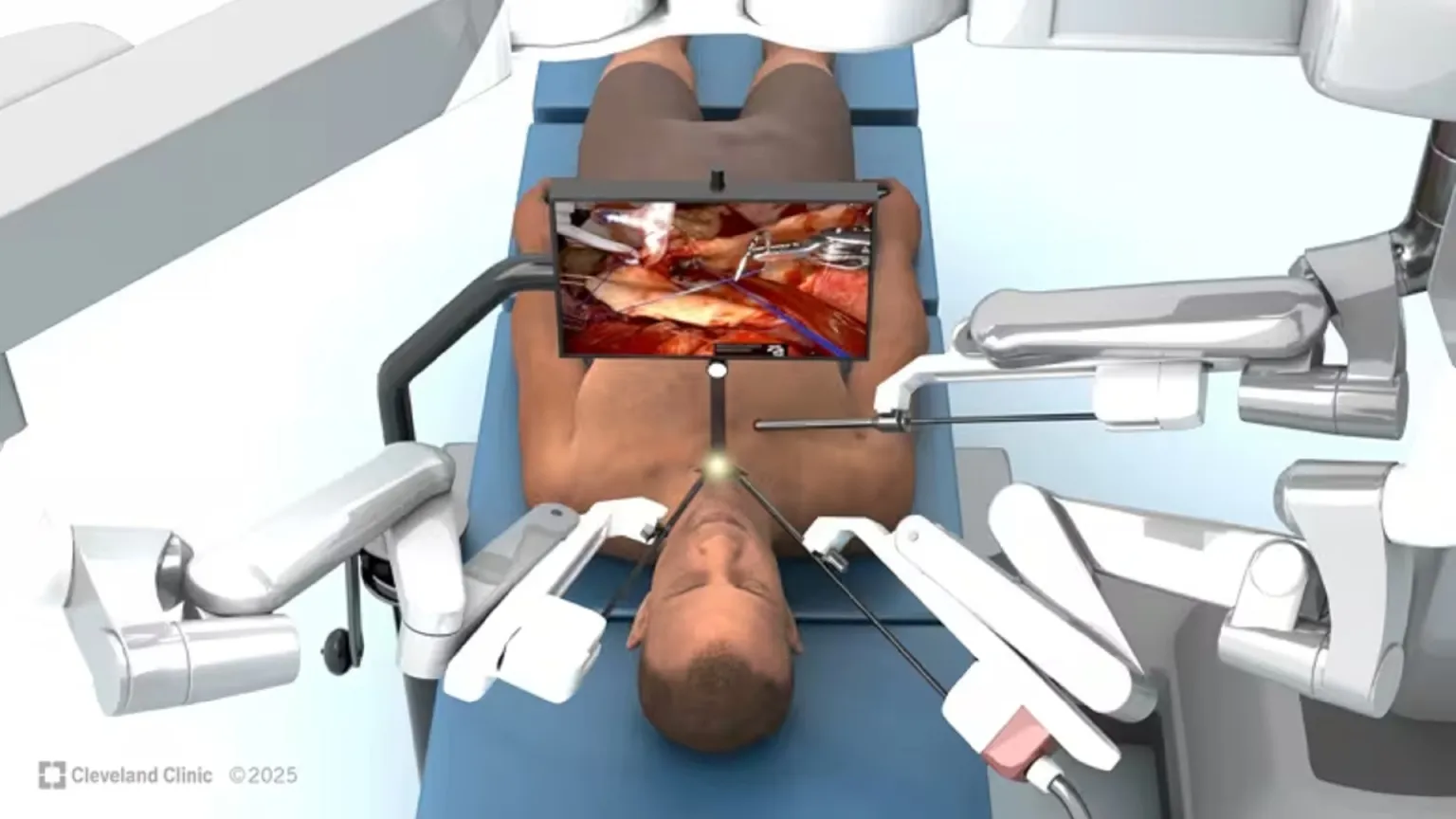 تعویض دریچه قلب بدون باز کردن قفسه سینه برای اولین بار در جهان