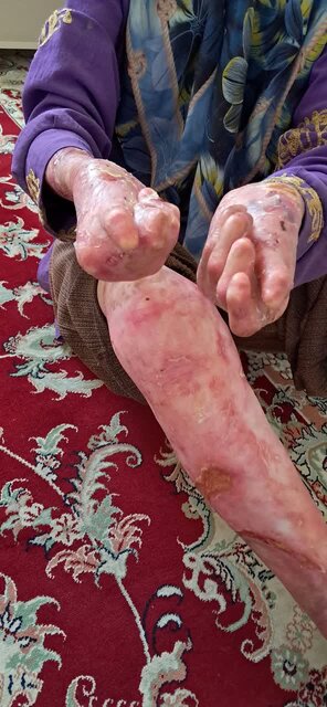 زندگی در قاب زخمها، روایت خانوادهای مبتلا به بیماری پروانهای در تویسرکان