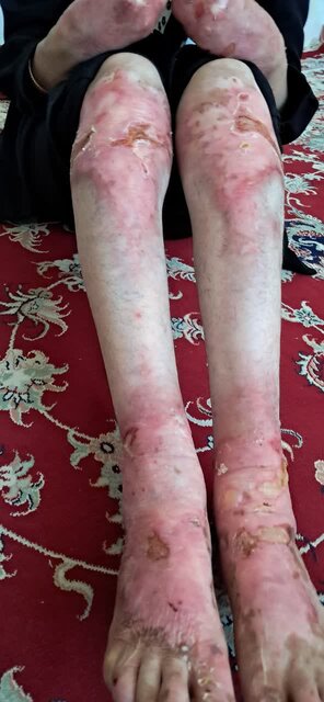 زندگی در قاب زخمها، روایت خانوادهای مبتلا به بیماری پروانهای در تویسرکان