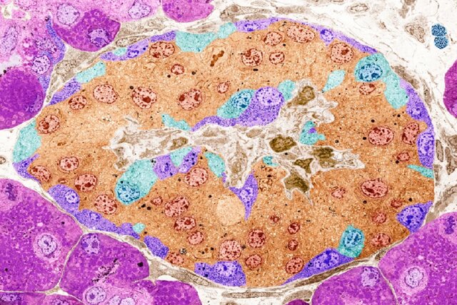 جزایر لانگرهانس با رنگآمیزی مصنوعی ویرایش ژن، امیدی تازه برای درمان دیابت نوع یک