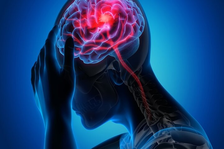 تایید ارتباط عجیب برداشتن رحم با سکته مغزی