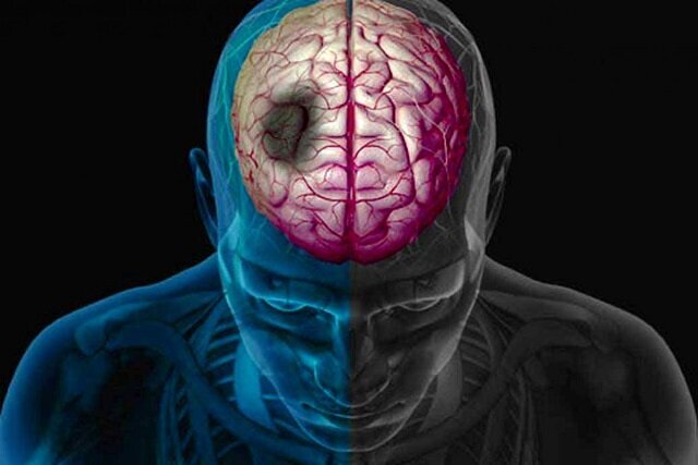 ترکیبات طبیعی، امید تازه در کاهش آسیب‌های سکته مغزی