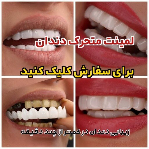 لمینت متحرک دندان راهی برای لبخند رویایی شما بدون دندان‌پزشکی