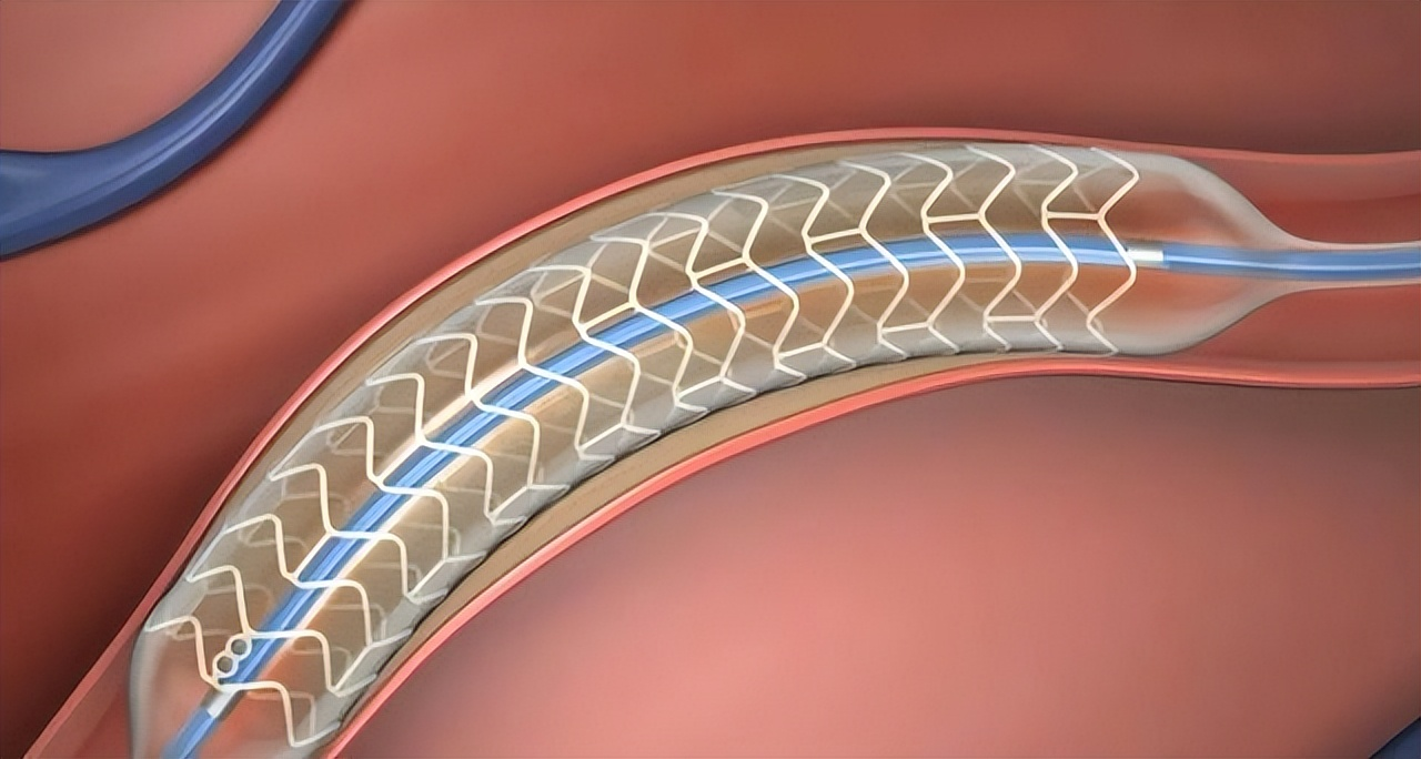 طول عمر فنر قلب چقدر است و چگونه بیشتر میشود