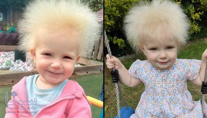 سندرومی به نام «موی اینشتین»