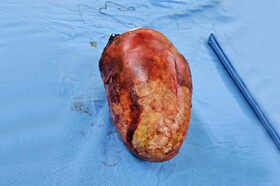 ماجرای جنین «مومیایی‌شده» در رحم زنی سالمند در مشهد از زبان پزشک جراح