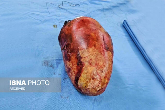 عکس از آرشیو ماجرای جنین «مومیاییشده» در رحم زنی سالمند در مشهد از زبان پزشک جراح