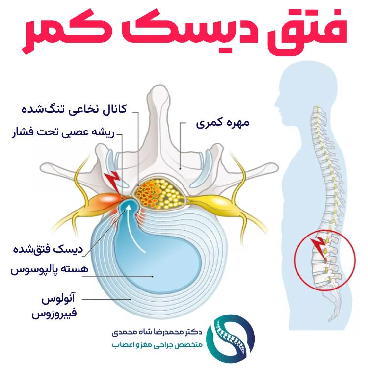 عمل لیزر دیسک کمر چگونه کمردرد را درمان میکند/پاسخ متخصص دیسک کمر