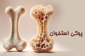 کم‌تحرکی مردم ایلام، از عوامل پوکی استخوان است