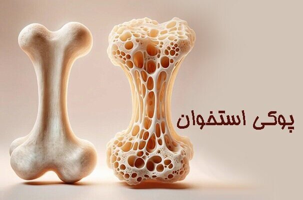 کم‌تحرکی مردم ایلام، از عوامل پوکی استخوان است