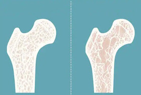 راهکارهای پیشگیری از پوکی استخوان در دوران میانسالی