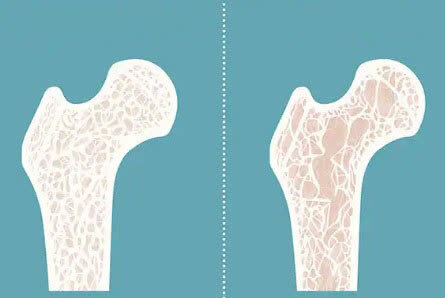راهکارهای پیشگیری از پوکی استخوان در دوران میانسالی