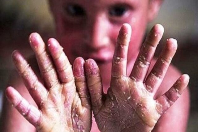 عکس تزیینی است. درخواست «خانه ایبی» از بنیاد بیماریهای خاص: فهرست خدمات قابل ارایه به بیماران ایبی را اعلام کنید