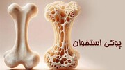 «پوکی استخوان»؛ بیماری خاموشی که با یک عطسه هم شکستگی می‌آورد