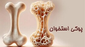 پوکی استخوان؛ تشخیص و درمان به‌ موقع