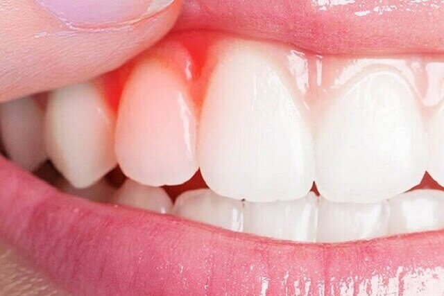 کیفیت پایین خواب، رهاورد بیماریهای لثه کیفیت پایین خواب، رهاورد بیماریهای لثه