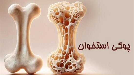پوکی استخوان؛ تشخیص و درمان به موقع پوکی استخوان؛ تشخیص و درمان به موقع