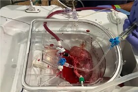 پیوند اولین کلیه هیبریدی انسان-خوک در اسپانیا