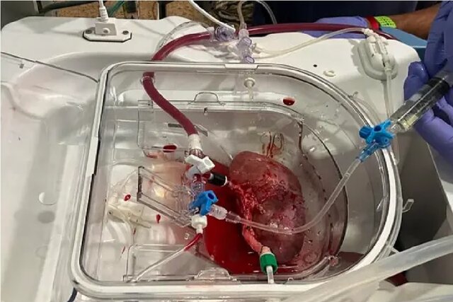 پیوند اولین کلیه هیبریدی انسان-خوک در اسپانیا پیوند اولین کلیه هیبریدی انسان-خوک در اسپانیا