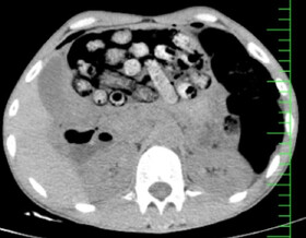 خروج ۹۰ بسته مواد مخدر از معده و روده یک بیمار در کرج