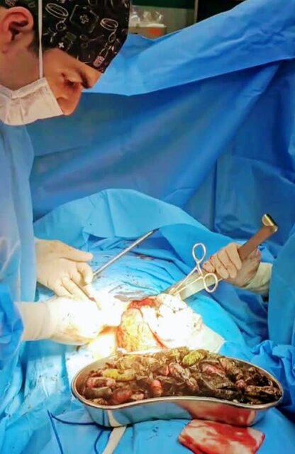 خروج بیش از ۹۰ بسته مواد مخدر از معده و روده یک بیمار در کرج