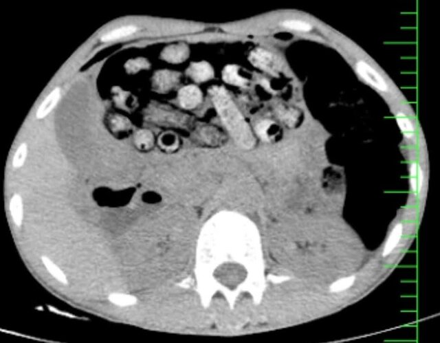 خروج ۹۰ بسته مواد مخدر از معده و روده یک بیمار در کرج