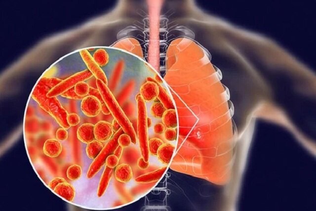 عکس تزیینی است. بیماری انسدادی مزمن ریه چهارمین علت مرگومیر جهان است