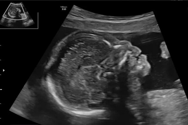 آیا تشخیص زودهنگام «سندرم داون» با شاخص استخوان بینی ممکن است؟