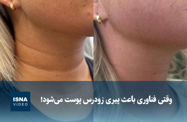 ویدیو/ وقتی فناوری باعث پیری زودرس پوست میشود! ویدیو/ وقتی فناوری باعث پیری زودرس پوست میشود!