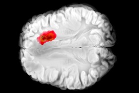 کشف دارویی برای مبارزه با کشنده‌ترین سرطان‌های مغز