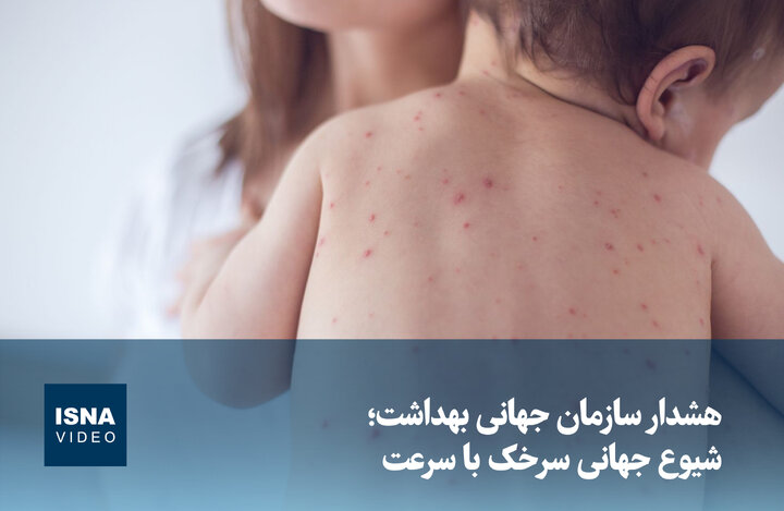 ویدیو/ هشدار سازمان جهانی بهداشت؛ شیوع جهانی سرخک با سرعت