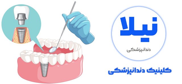افزایش تقاضای ایمپلنت دندان در تهران و کرج