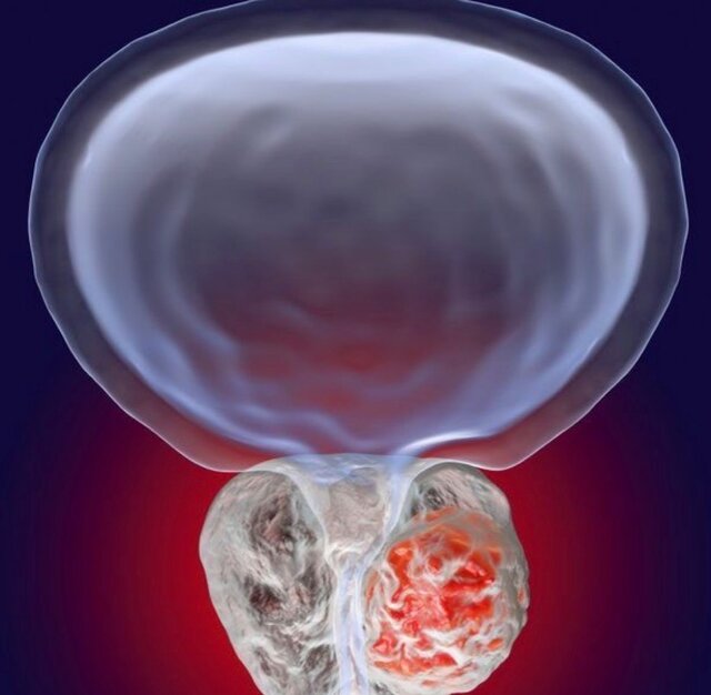 پروستات؛ غده‌ای کوچک با نقشی بزرگ در سلامت مردان