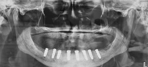 کاشت دندان یک روزه با لیزر فناوری جدید ایمپلنت