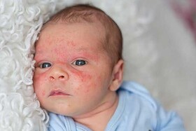 امکان بهبودی اگزمای پوستی نوزادان با افزایش سن